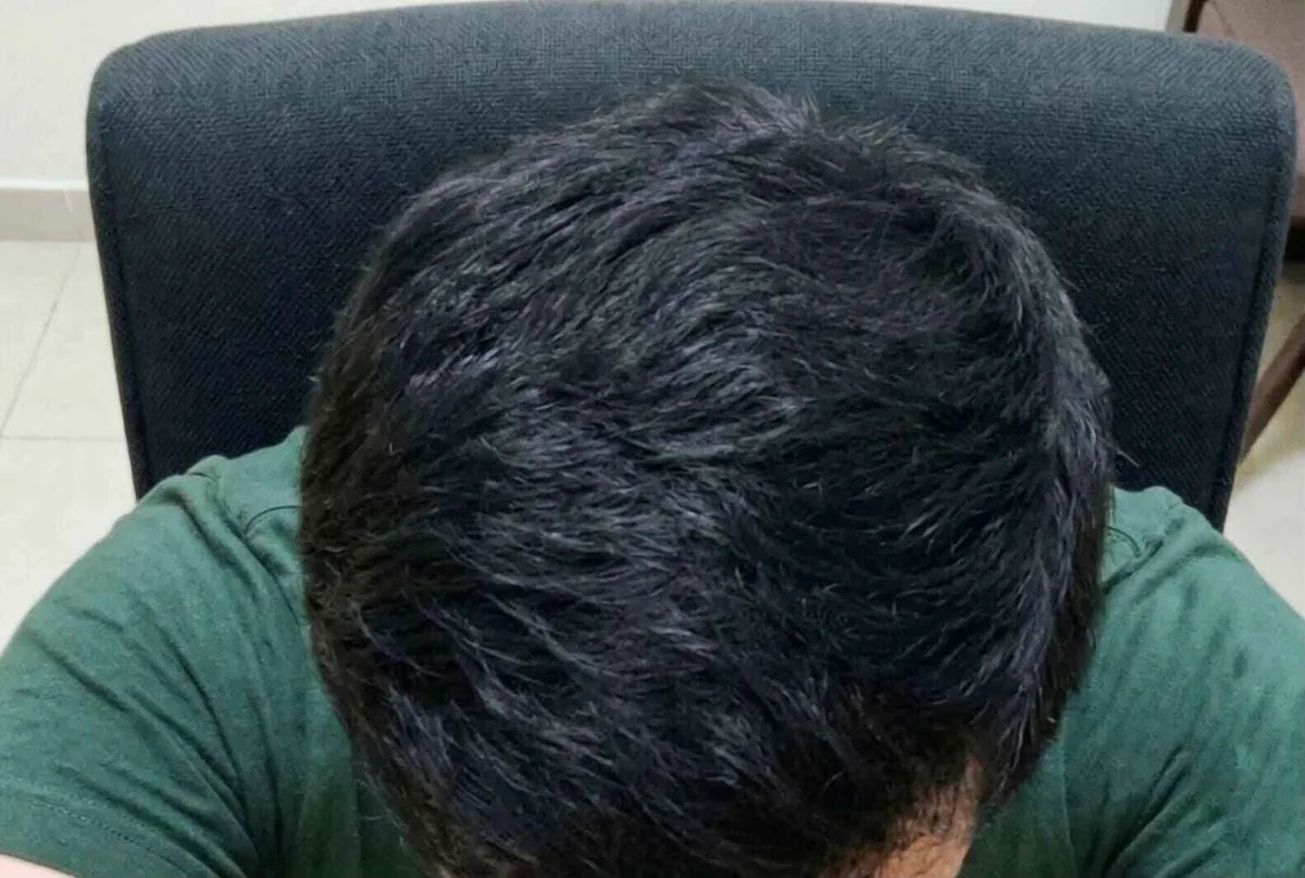 Arjun's hair after six months using Enigma