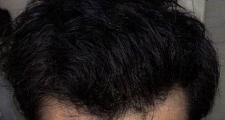 Rahul's fuller-looking hair after six months using Enigma