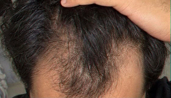 Rahul's hairline before using Enigma