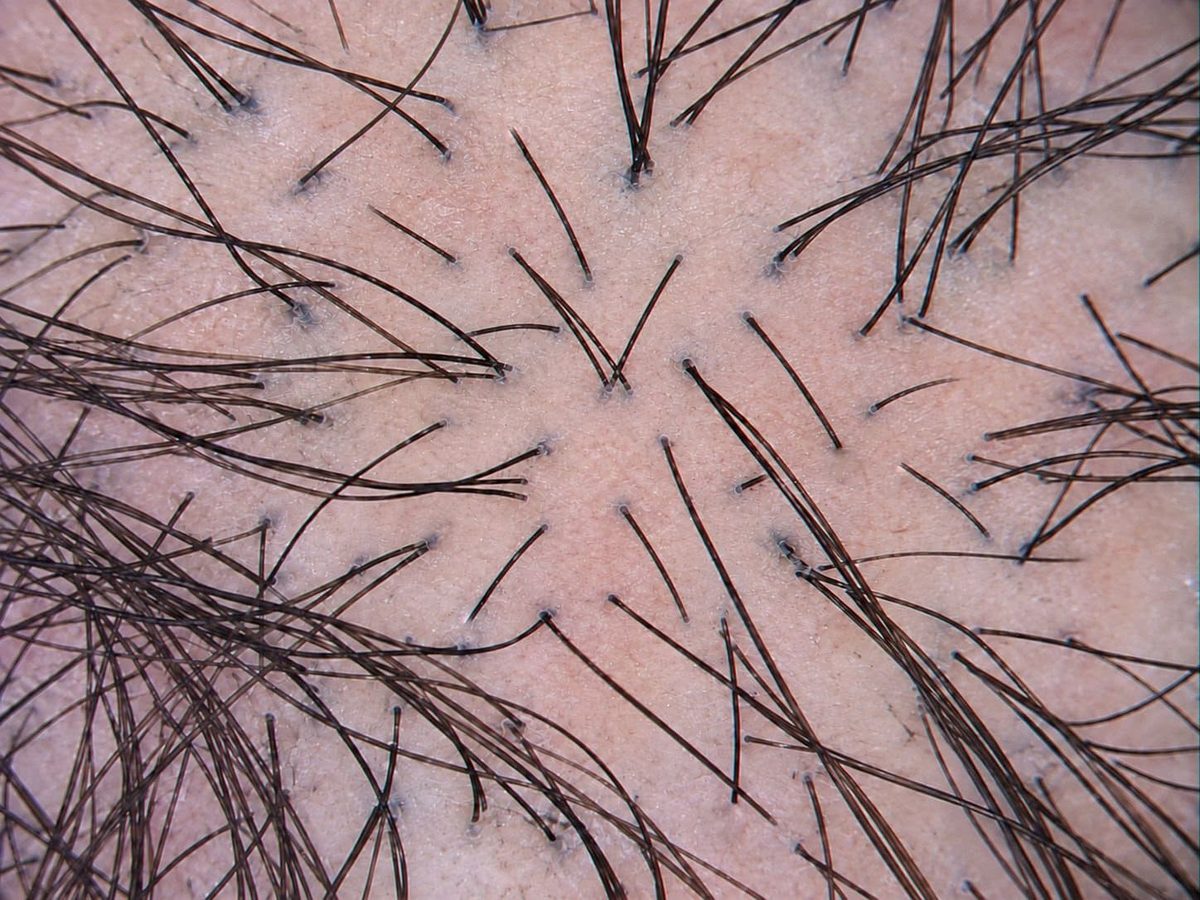 Week 4 trichoscopy showing a healthier-looking scalp