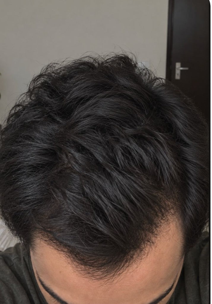 Rahul's fuller-looking hair after five months using Enigma