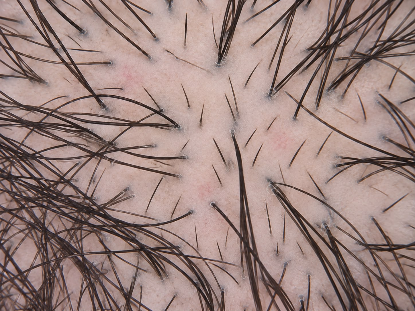 Week 4 trichoscopy showing a healthier-looking scalp